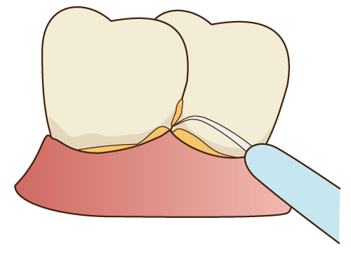 軽度歯周病の場合
